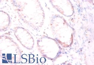 FOLH1 / PSMA Antibody - Immunohistochemistry of paraffin-embedded human colorectal carcinoma using FOLH1 / PSMA antibody at dilution of 1:50.  This image was taken for the unconjugated form of this product. Other forms have not been tested.
