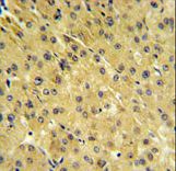 FOLH1B Antibody - PSMAL Antibody IHC of formalin-fixed and paraffin-embedded hepatocarcinoma followed by peroxidase-conjugated secondary antibody and DAB staining.