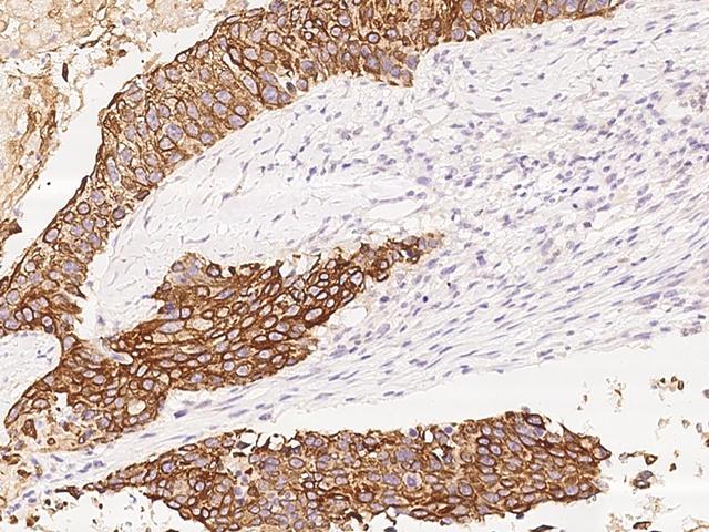FOLR1 / Folate Receptor Alpha Antibody - AImmunochemical staining of human FOLR1 in human lung cancer with rabbit polyclonal antibody at 1:1000 dilution, formalin-fixed paraffin embedded sections.