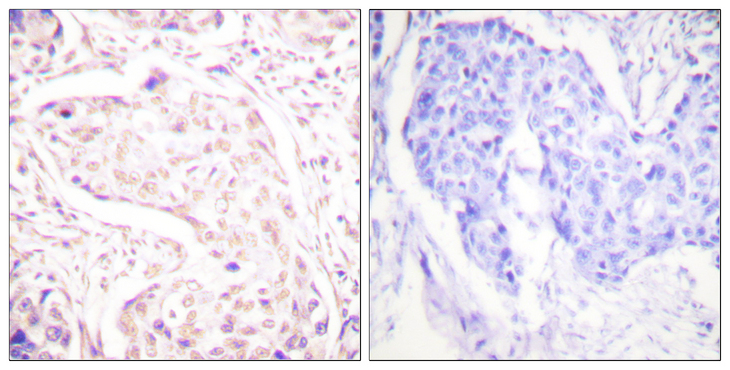 FOS / c-FOS Antibody - Immunohistochemistry analysis of paraffin-embedded human breast carcinoma tissue, using Fos Antibody. The picture on the right is blocked with the synthesized peptide.