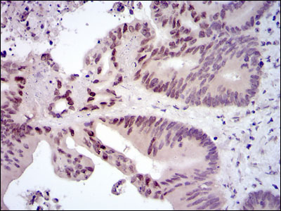 FOS / c-FOS Antibody - IHC of paraffin-embedded colon cancer tissues using FOS mouse monoclonal antibody with DAB staining.