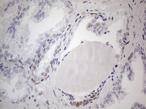 FOS / c-FOS Antibody - Immunohistochemical staining of paraffin-embedded Carcinoma of Human prostate tissue using anti-FOS mouse monoclonal antibody. (Heat-induced epitope retrieval by 1mM EDTA in 10mM Tris buffer. (pH8.5) at 120°C for 3 min. (1:150)(1:200)