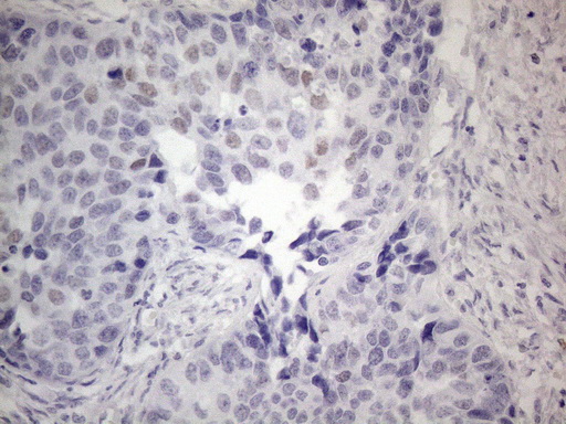 FOS / c-FOS Antibody - Immunohistochemical staining of paraffin-embedded Carcinoma of Human kidney tissue using anti-FOS mouse monoclonal antibody. (Heat-induced epitope retrieval by 1mM EDTA in 10mM Tris buffer. (pH8.5) at 120°C for 3 min. (1:150)(1:200)