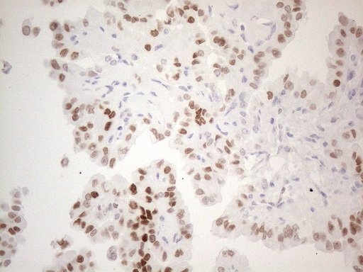 FOS / c-FOS Antibody - Immunohistochemical staining of paraffin-embedded Carcinoma of Human thyroid tissue using anti-FOS mouse monoclonal antibody. (Heat-induced epitope retrieval by 1mM EDTA in 10mM Tris buffer. (pH8.5) at 120°C for 3 min. (1:150)(1:200)