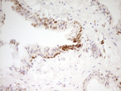 FOS / c-FOS Antibody - Immunohistochemical staining of paraffin-embedded Carcinoma of Human prostate tissue using anti-FOS mouse monoclonal antibody. (Heat-induced epitope retrieval by 1 mM EDTA in 10mM Tris, pH8.5, 120C for 3min,