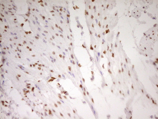 FOS / c-FOS Antibody - Immunohistochemical staining of paraffin-embedded Human bladder tissue within the normal limits using anti-FOS mouse monoclonal antibody. (Heat-induced epitope retrieval by 1 mM EDTA in 10mM Tris, pH8.5, 120C for 3min,