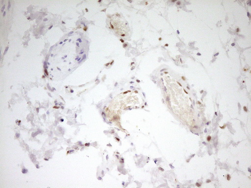 FOS / c-FOS Antibody - Immunohistochemical staining of paraffin-embedded Carcinoma of Human bladder tissue using anti-FOS mouse monoclonal antibody. (Heat-induced epitope retrieval by 1 mM EDTA in 10mM Tris, pH8.5, 120C for 3min,