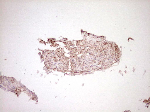 FOS / c-FOS Antibody - Immunohistochemical staining of paraffin-embedded Adenocarcinoma of Human endometrium tissue using anti-FOS mouse monoclonal antibody. (Heat-induced epitope retrieval by 1 mM EDTA in 10mM Tris, pH8.5, 120C for 3min,
