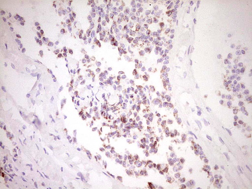 FOS / c-FOS Antibody - Immunohistochemical staining of paraffin-embedded Carcinoma of Human lung tissue using anti-FOS mouse monoclonal antibody. (Heat-induced epitope retrieval by 1 mM EDTA in 10mM Tris, pH8.5, 120C for 3min,