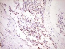 FOS / c-FOS Antibody - Immunohistochemical staining of paraffin-embedded Carcinoma of Human lung tissue using anti-FOS mouse monoclonal antibody. (Heat-induced epitope retrieval by 1 mM EDTA in 10mM Tris, pH8.5, 120C for 3min,