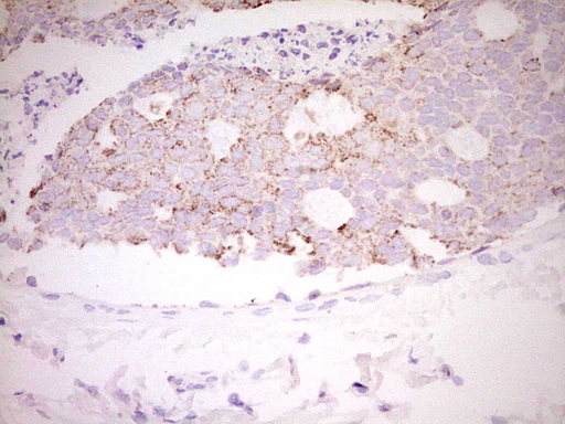 FOS / c-FOS Antibody - Immunohistochemical staining of paraffin-embedded Adenocarcinoma of Human breast tissue using anti-FOS mouse monoclonal antibody. (Heat-induced epitope retrieval by 1 mM EDTA in 10mM Tris, pH8.5, 120C for 3min,