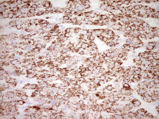 FOS / c-FOS Antibody - Immunohistochemical staining of paraffin-embedded Carcinoma of Human liver tissue using anti-FOS mouse monoclonal antibody. (Heat-induced epitope retrieval by 1 mM EDTA in 10mM Tris, pH8.5, 120C for 3min,
