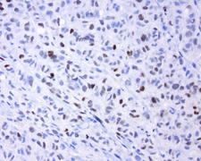 FOS / c-FOS Antibody - Immunohistochemical staining of paraffin-embedded human melanoma using anti-FOS clone UMAB221 at 1:200 dilution of 0.5 mg/mL and detection with Polink2 Broad HRP DAB.requires heat-induced epitope retrieval with ACCEL. (pH8.7) biocare pressure cooker. The image shows nuclear staining in tumor cells.