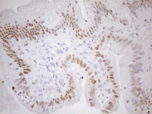 FOS / c-FOS Antibody - Immunohistochemical staining of paraffin-embedded Carcinoma of Human pancreas tissue using anti-FOS mouse monoclonal antibody.HIER pretreatment was done with 1mM EDTA in 10mM Tris buffer. (pH8.0) at 120°C for 2.5 minutes.was diluted 1:200 and detection was done with HRP secondary and DAB chromogen. Nuclear staining seen in tumor cells.