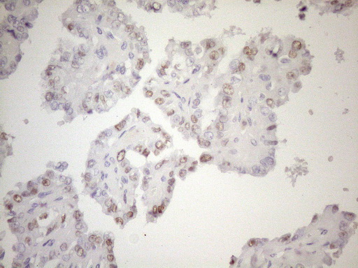 FOS / c-FOS Antibody - Immunohistochemical staining of paraffin-embedded carcinoma of human thyroid tissue using anti-FOS mouse monoclonal antibody.HIER pretreatment was done with 1mM EDTA in 10mM Tris buffer. (pH8.0) at 120°C for 2.5 minutes.was diluted 1:200 and detection was done with HRP secondary and DAB chromogen. Nuclear staining seen in tumor cells.
