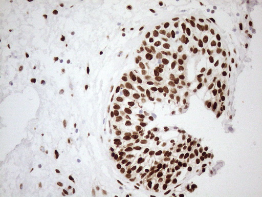 FOS / c-FOS Antibody - Immunohistochemical staining of paraffin-embedded Carcinoma of Human prostate tissue using anti-FOS mouse monoclonal antibody.HIER pretreatment was done with 1mM EDTA in 10mM Tris buffer. (pH8.0) at 120°C for 2.5 minutes.was diluted 1:200 and detection was done with HRP secondary and DAB chromogen. Nuclear staining seen in tumor cells.
