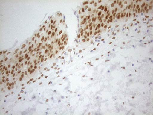 FOS / c-FOS Antibody - Immunohistochemical staining of paraffin-embedded human bladder tissue within the normal limits using anti-FOS mouse monoclonal antibody.HIER pretreatment was done with 1mM EDTA in 10mM Tris buffer. (pH8.0) at 120°C for 2.5 minutes.was diluted 1:200 and detection was done with HRP secondary and DAB chromogen. Nuclear staining seen in epithelial cells.
