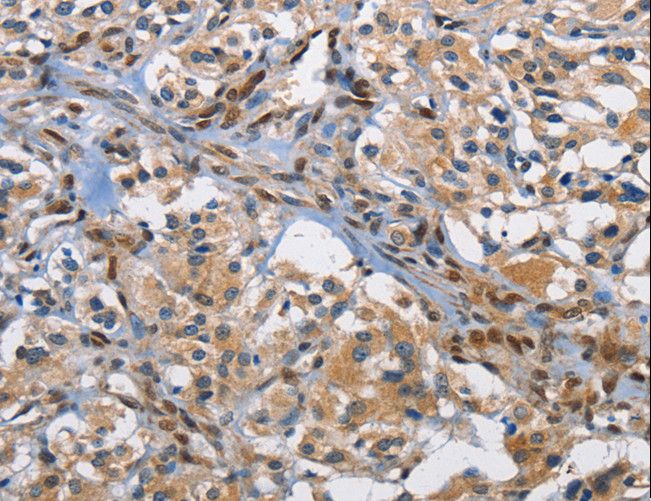 FOS / c-FOS Antibody - Immunohistochemistry of paraffin-embedded Human thyroid cancer using FOS Polyclonal Antibody at dilution of 1:70.