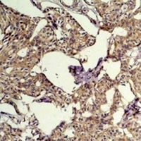 FOS / c-FOS Antibody - Immunohistochemical analysis of c-FOS staining in human breast cancer formalin fixed paraffin embedded tissue section. The section was pre-treated using heat mediated antigen retrieval with sodium citrate buffer (pH 6.0). The section was then incubated with the antibody at room temperature and detected using an HRP conjugated compact polymer system. DAB was used as the chromogen. The section was then counterstained with hematoxylin and mounted with DPX.