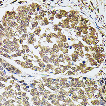FOS / c-FOS Antibody - Immunohistochemistry of paraffin-embedded human esophageal cancer using FOS antibody at dilution of 1:100 (40x lens).