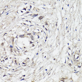 FOS / c-FOS Antibody - Immunohistochemistry of paraffin-embedded human gastric cancer using C-FOS antibody at dilution of 1:150 (40x lens).