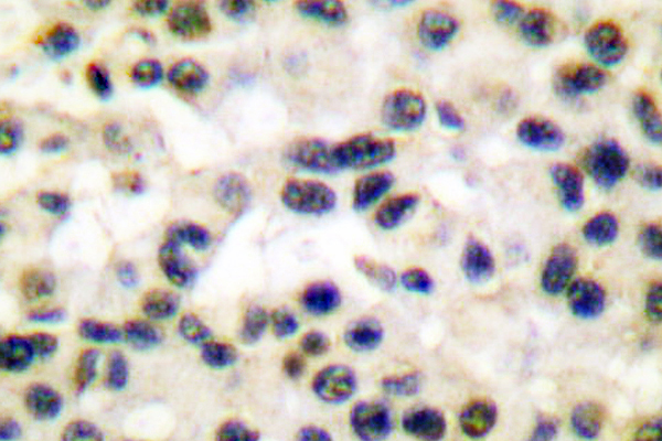 FOS / c-FOS Antibody - IHC of Fos (F3) pAb in paraffin-embedded human breast carcinoma tissue.