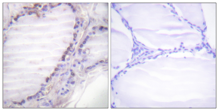 FOS / c-FOS Antibody - Immunohistochemistry analysis of paraffin-embedded human thyroid gland, using Fos (Phospho-Ser362) Antibody. The picture on the right is blocked with the phospho peptide.