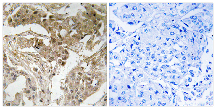 FOS / c-FOS Antibody - Immunohistochemistry analysis of paraffin-embedded human breast carcinoma, using FOS (Phospho-Thr232) Antibody. The picture on the right is blocked with the phospho peptide.
