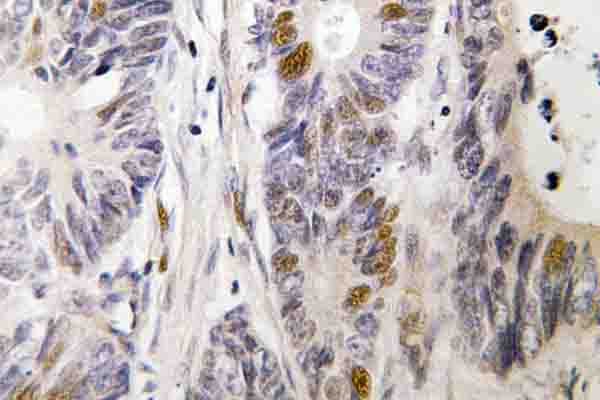 FOS / c-FOS Antibody - IHC of c-Fos (S368) pAb in paraffin-embedded human colon carcinoma tissue.