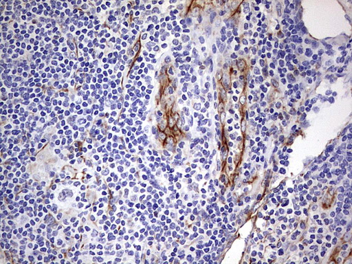 FOSB Antibody - Immunohistochemical staining of paraffin-embedded Human lymphoma tissue using anti-FOSB mouse monoclonal antibody.  Dilution: 1:150