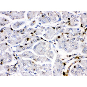 FOSB Antibody - Fos B antibody IHC-paraffin. IHC(P): Human Pancreatic Cancer Tissue.