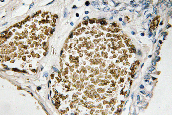 FOSB Antibody - IHC of FosB (Ser23) pAb in paraffin-embedded human prostate carcinoma tissue.