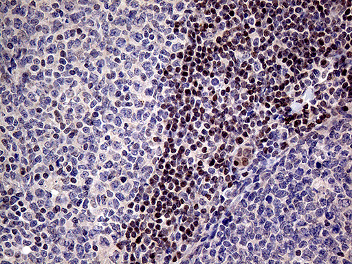 FOSL2 / FRA-2 Antibody - Immunohistochemical staining of paraffin-embedded Human tonsil within the normal limits using anti-FOSL2 mouse monoclonal antibody. (Heat-induced epitope retrieval by 1mM EDTA in 10mM Tris buffer. (pH8.5) at 120°C for 3 min. (1:2000)