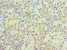 FOSL2 / FRA-2 Antibody - Immunohistochemistry of paraffin-embedded human breast cancer using antibody at 1:100 dilution.
