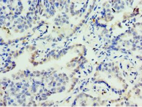 FOSL2 / FRA-2 Antibody - Immunohistochemistry of paraffin-embedded human lung cancer using antibody at 1:100 dilution.