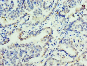 FOSL2 / FRA-2 Antibody - Immunohistochemistry of paraffin-embedded human lung cancer using FOSL2 Antibody at dilution of 1:100