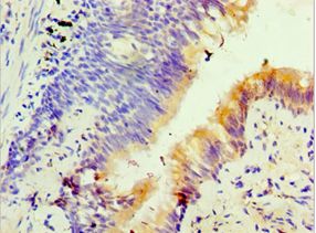 FOSL2 / FRA-2 Antibody - Immunohistochemistry of paraffin-embedded human lung cancer using antibody at 1:100 dilution.
