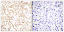 FOSL2 / FRA-2 Antibody - Immunohistochemistry analysis of paraffin-embedded human breast carcinoma tissue, using Fra-2 Antibody. The picture on the right is blocked with the synthesized peptide.