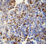 FOSL2 / FRA-2 Antibody - FOSL2 antibody immunohistochemistry of formalin-fixed and paraffin-embedded human lung carcinoma followed by peroxidase-conjugated secondary antibody and DAB staining.
