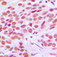 FOSL2 / FRA-2 Antibody - Immunohistochemical analysis of FRA2 staining in human breast cancer formalin fixed paraffin embedded tissue section. The section was pre-treated using heat mediated antigen retrieval with sodium citrate buffer (pH 6.0). The section was then incubated with the antibody at room temperature and detected using an HRP conjugated compact polymer system. DAB was used as the chromogen. The section was then counterstained with hematoxylin and mounted with DPX.