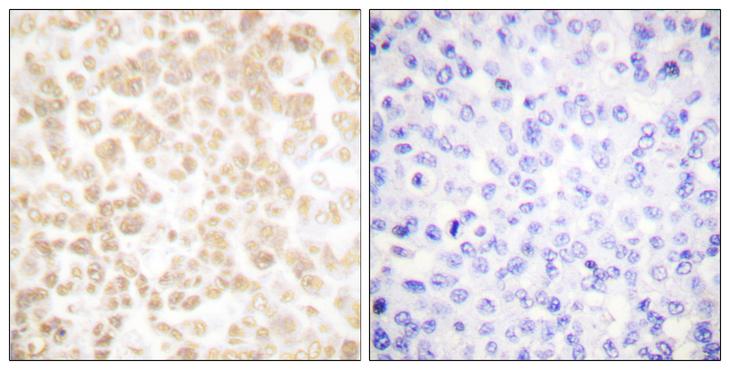 FOSL2 / FRA-2 Antibody - Peptide - + Immunohistochemical analysis of paraffin-embedded human breast carcinoma tissue using Fra-2 antibody.