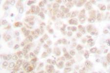 FOSL2 / FRA-2 Antibody - IHC of Fra-2/FOSL2 (S301) pAb in paraffin-embedded human breast carcinoma tissue.