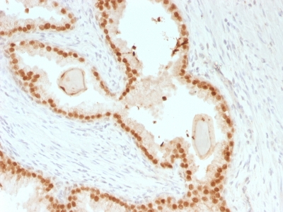 FOXA1 Antibody - Formalin-fixed, paraffin-embedded human Prostate Carcinoma stained with FOXA1 Mouse Recombinant Monoclonal Antibody (rFOXA1/1515).