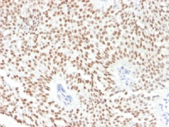 FOXA1 Antibody - IHC testing of FFPE human bladder carcinoma with FOXA1 antibody (clone FOXA1/1241). HIER: boil sections in 10mM Tris with 1mM EDTA, pH9 for 10-20 min followed by cooling at RT for 20 min.