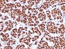 FOXA1 Antibody - IHC testing of FFPE human prostate carcinoma with FOXA1 antibody (clone FOXA1/1512). HIER: boil sections in 10mM Tris with 1mM EDTA, pH9, for 10-20 min.