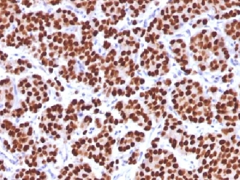 FOXA1 Antibody - IHC testing of FFPE human prostate carcinoma with FOXA1 antibody (clone FOXA1/1512). HIER: boil sections in 10mM Tris with 1mM EDTA, pH9, for 10-20 min.