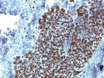 FOXA1 Antibody - IHC testing of FFPE human prostate carcinoma with FOXA1 antibody (clone FOXA1/1514). HIER: boil sections in 10mM Tris with 1mM EDTA, pH9, for 10-20 min.