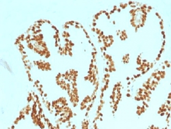 FOXA1 Antibody - IHC testing of FFPE human prostate carcinoma with FOXA1 antibody (clone FOXA1/1515). HIER: boil sections in 10mM Tris with 1mM EDTA, pH9, for 10-20 min.