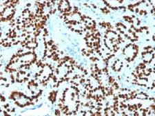 FOXA1 Antibody - IHC testing of FFPE human prostate carcinoma with FOXA1 antibody (clone FOXA1/1518). HIER: boil sections in 10mM Tris with 1mM EDTA, pH9, for 10-20 min.