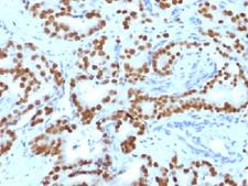 FOXA1 Antibody - IHC testing of FFPE human prostate carcinoma with FOXA1 antibody (clone FOXA1/1519). HIER: boil sections in 10mM Tris with 1mM EDTA, pH9, for 10-20 min.